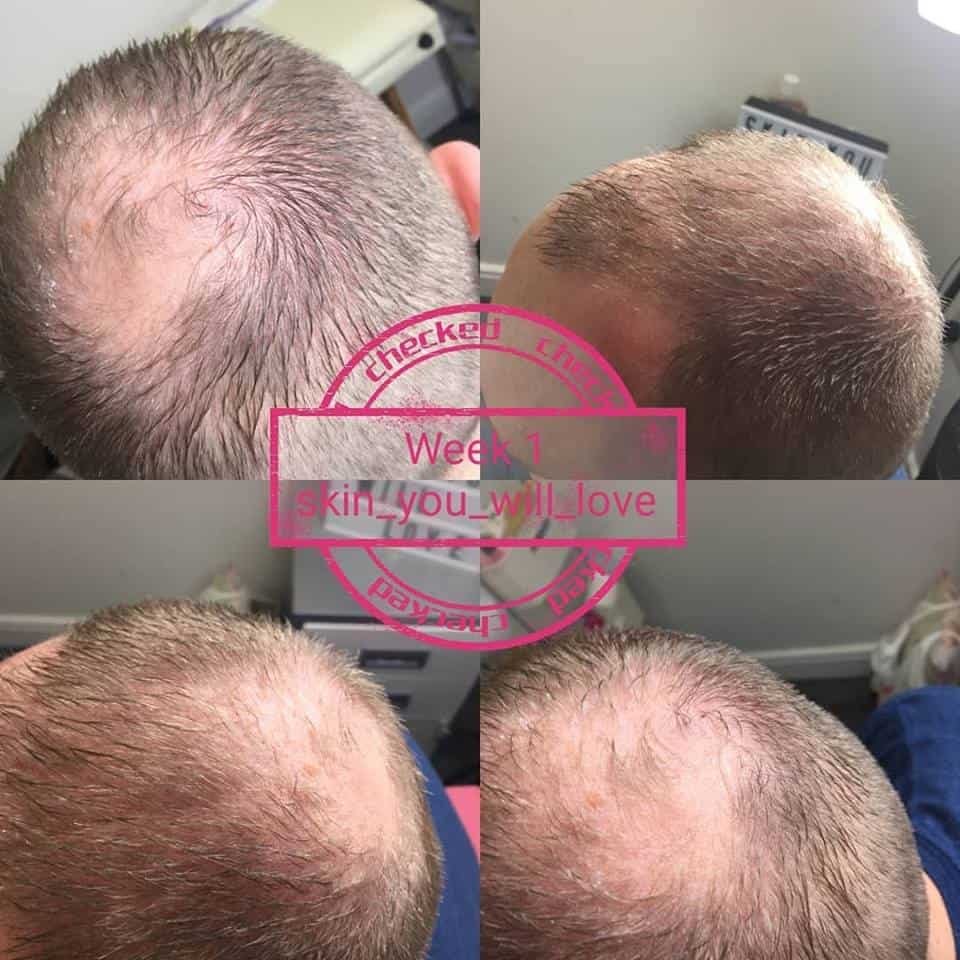 Hair Restoration Mesotherapy Treatment ⋆ Sophia Wyatt