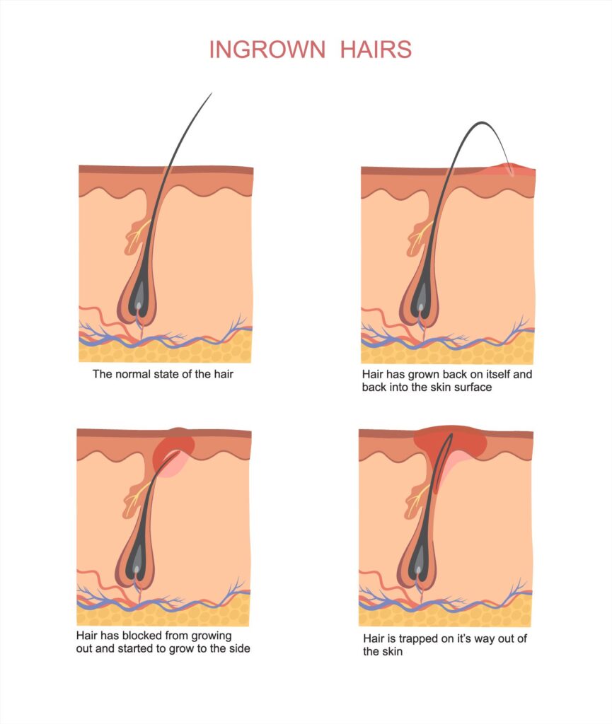 Permanent Solution for Ingrown And Unwanted Hair Growth ⋆ Sophia Wyatt
