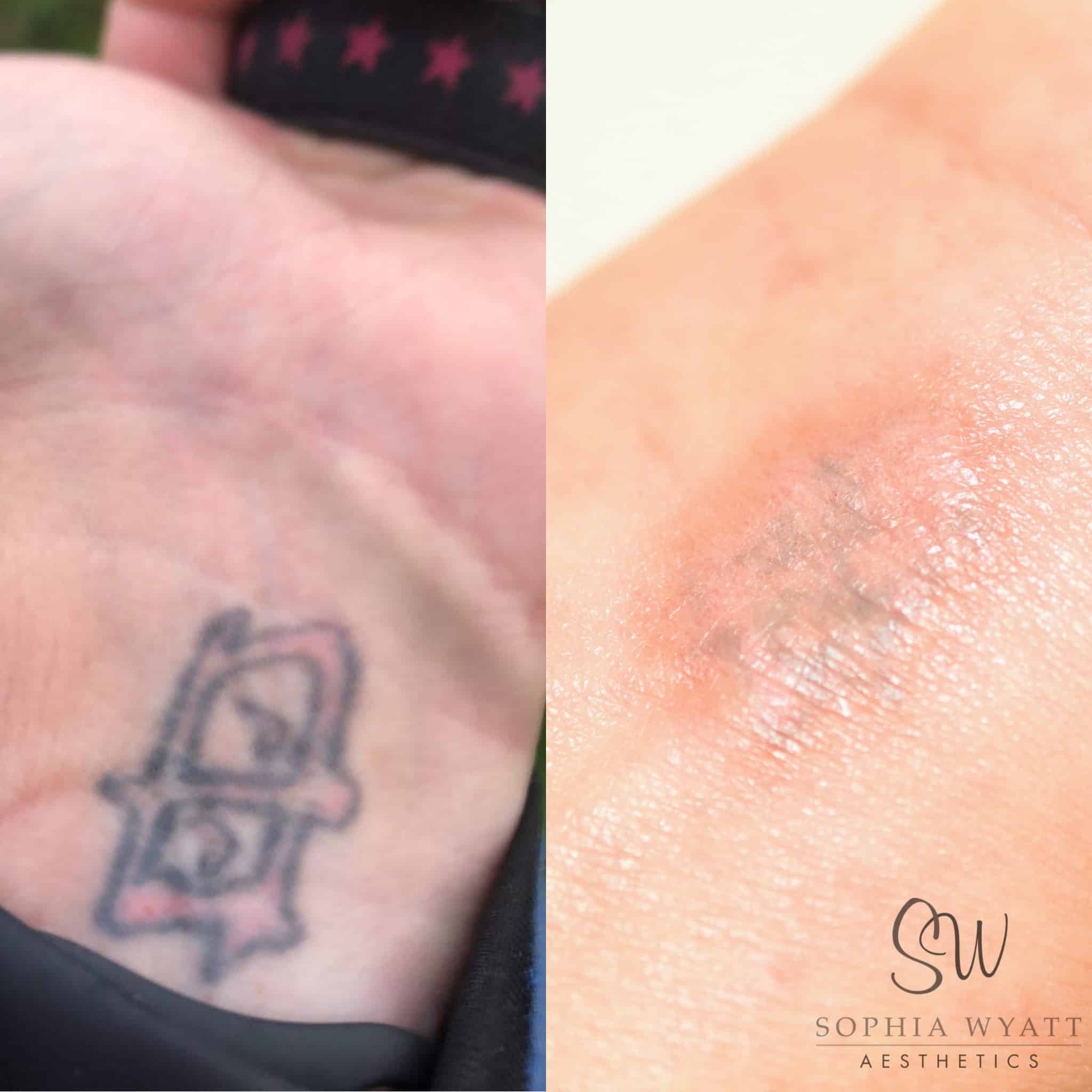 Xtract™ Non-laser, Holistic Tattoo Removal ⋆ Sophia Wyatt
