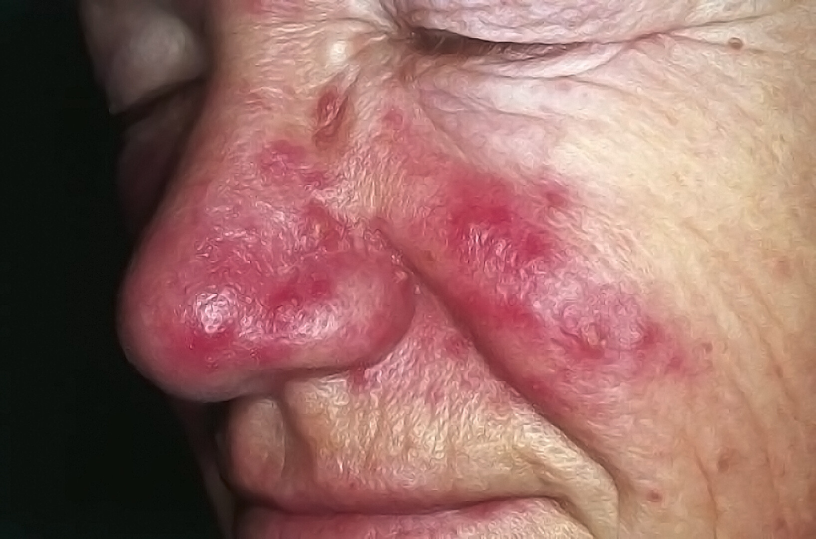 Granulomatous Rosacea - StoryMd